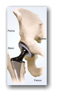 Pelvis Stem Socket Femur